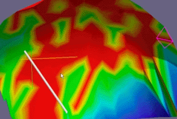 Imagen: Modelo de la superficie de la cabeza, codificado en colores, que presenta la relación de riesgo para una cierta trayectoria quirúrgica. Rojo significa área quirúrgica vedada y verde significa un área de menor riesgo para la incisión quirúrgica (Fotografía cortesía del Dr. Yigal Shoshan).